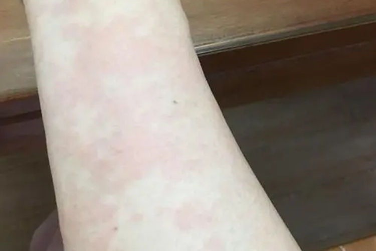 蚕丝被过敏手臂红斑图 蚕丝被过敏手臂红斑图