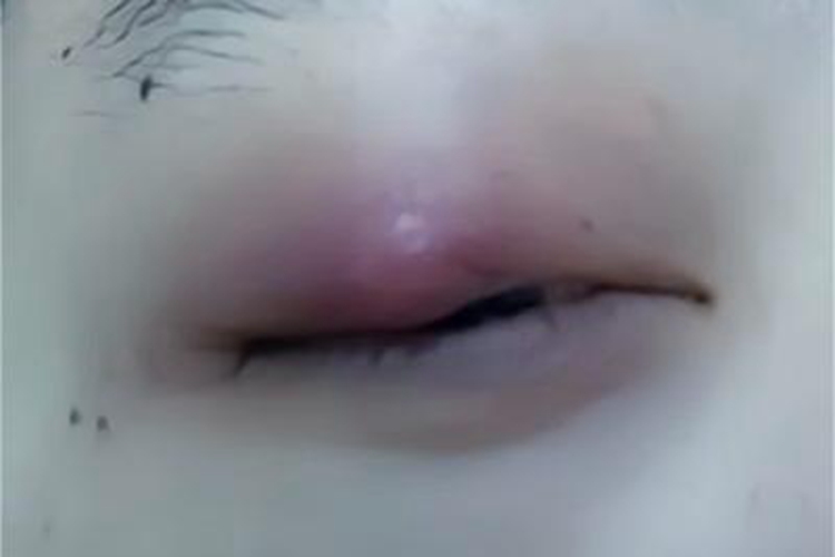 霰粒肿眼皮上长了个红疙瘩图