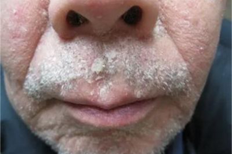 表浅型须癣口周脱屑图 表浅型须癣口周脱屑图