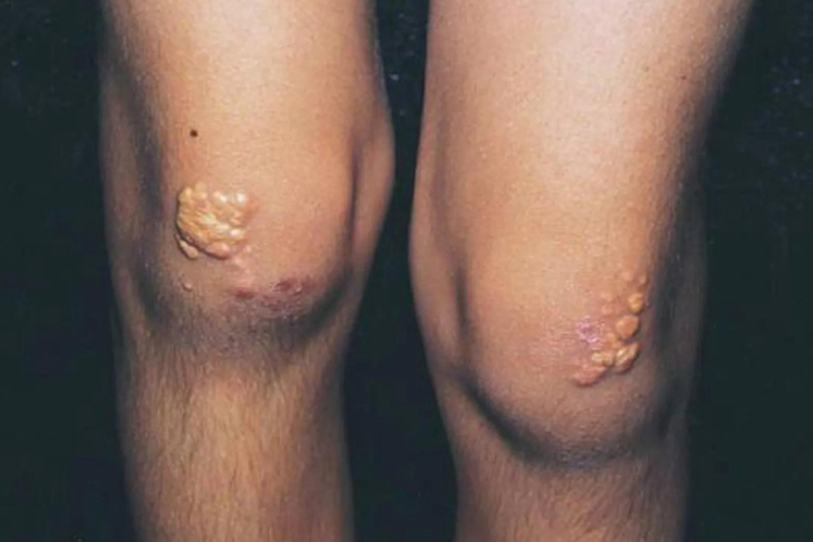 糖尿病黄色瘤图