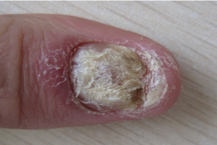 银屑病甲指甲部分缺损图