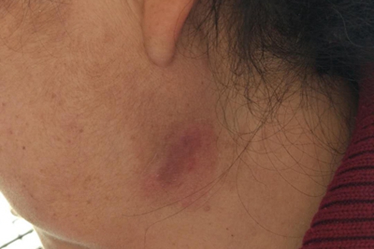 炎症后色素沉着侧颈斑图 炎症后色素沉着侧颈斑图