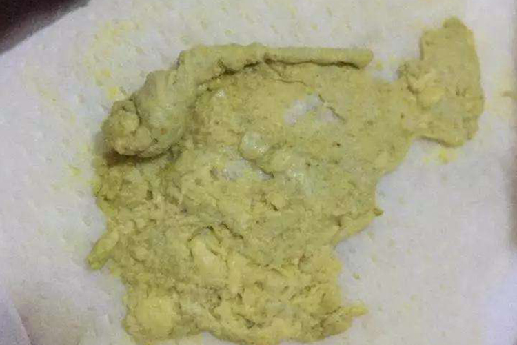 豆腐渣样大便图