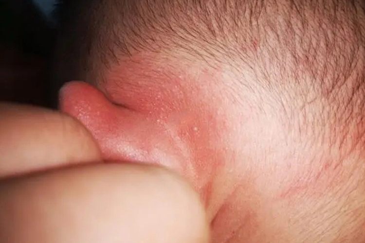 宝宝耳朵后荨麻疹图