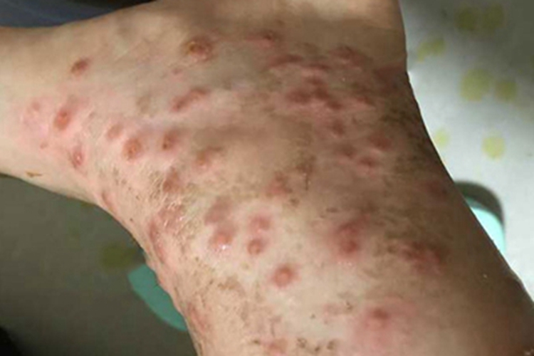 蠓虫叮咬小腿全是疙瘩图