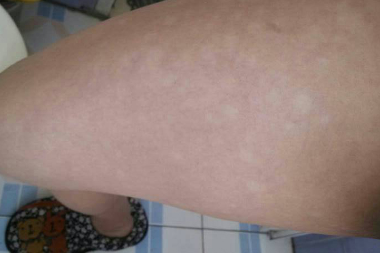 白色糠疹图 白色糠疹图