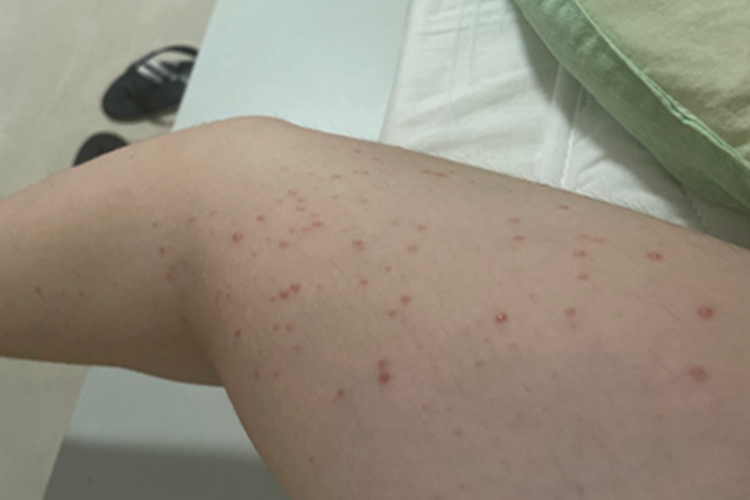 毛囊炎腿症状图