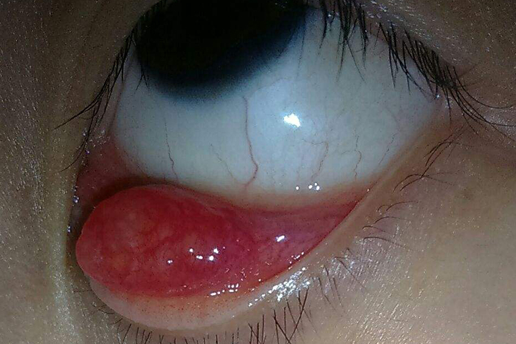 眼睑结膜炎症状图片图片