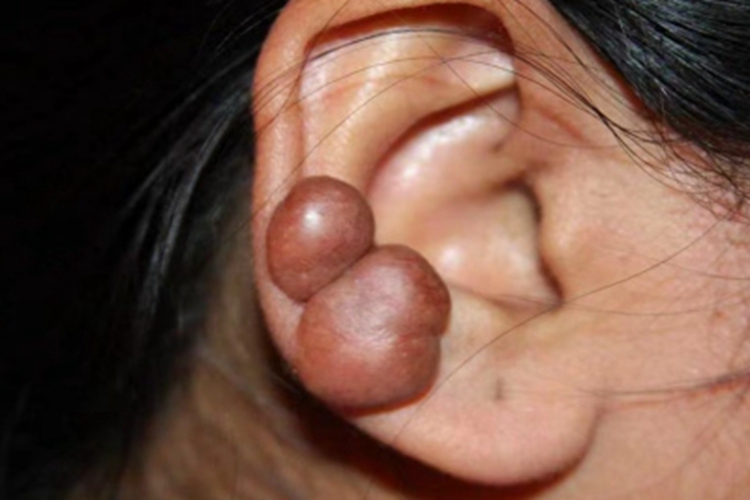 瘢痕疙瘩耳廓两个大肉疙瘩图 瘢痕疙瘩耳廓两个大肉疙瘩图