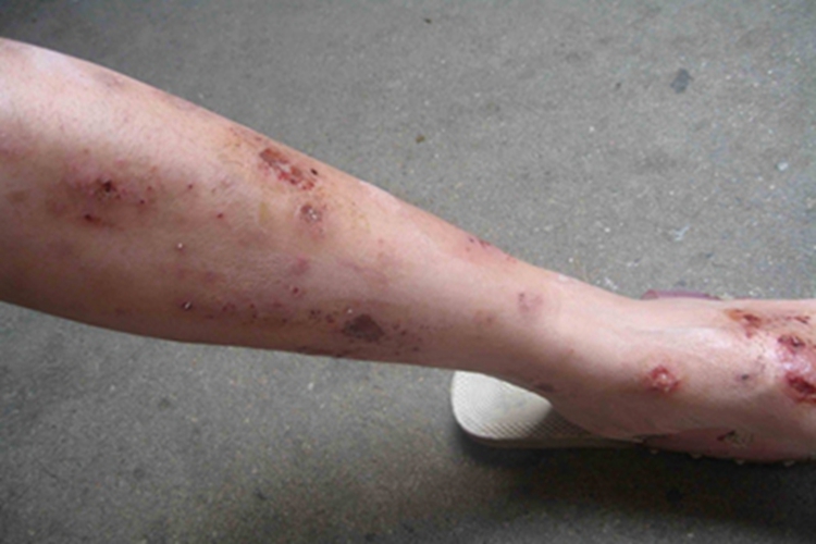 自体敏感性湿疹小腿结痂图