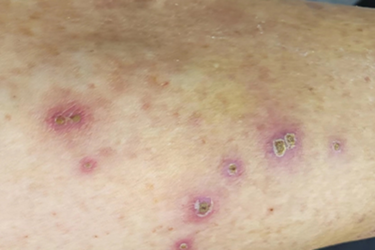 感染性湿疹小腿结痂图