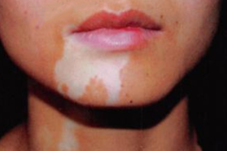 白癜风脸部片状白斑图