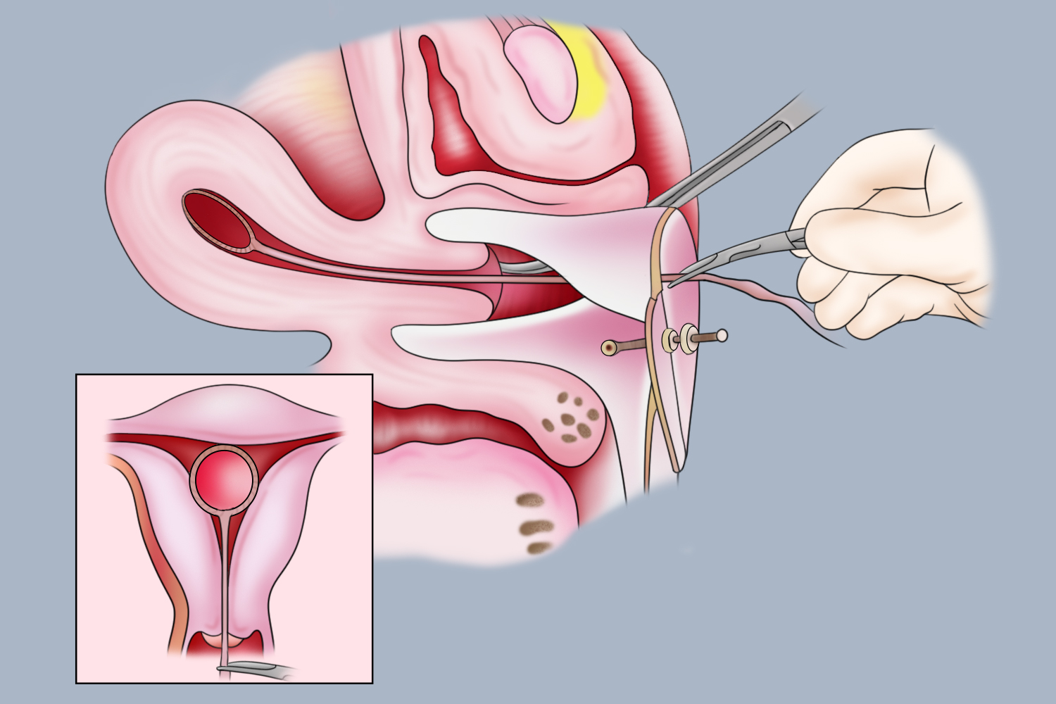 为什么取环后不怀孕
