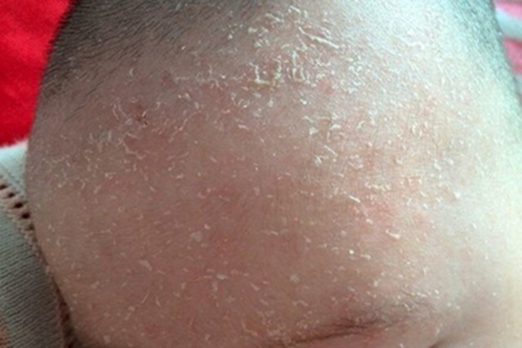 维生素A缺乏症症状图