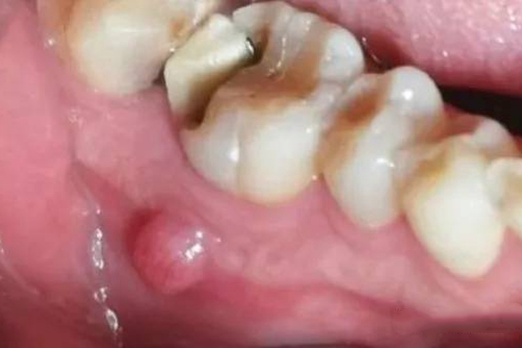 根尖肉芽肿牙周长了囊肿图