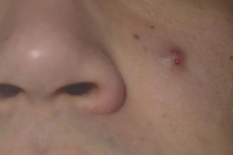 皮脂腺囊肿图 皮脂腺囊肿图