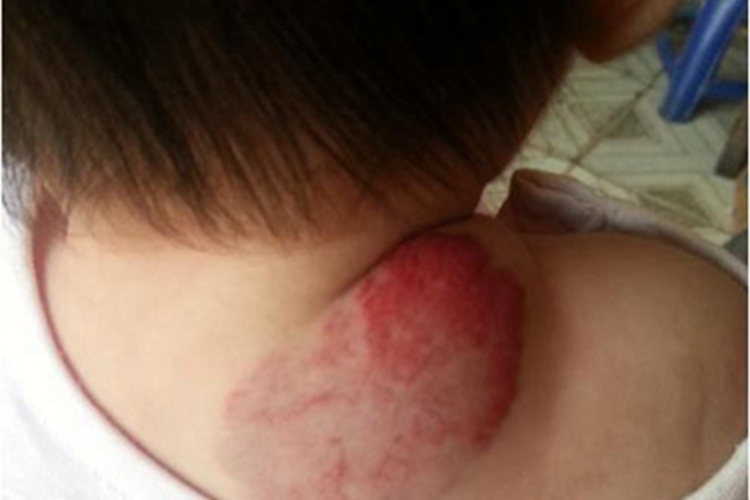 海绵状血管瘤后颈症状图