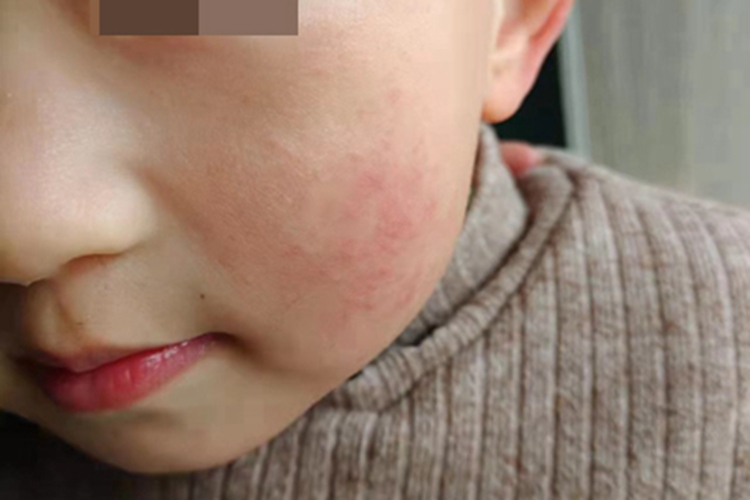 过敏性皮炎面部一小片红斑图