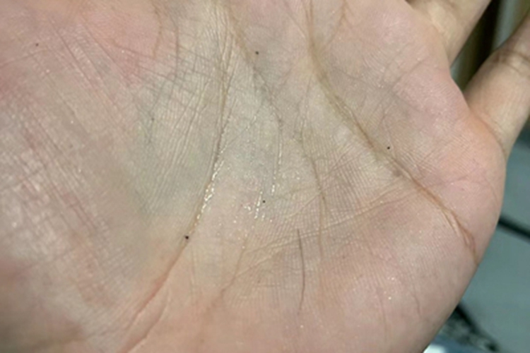 局限型多汗症手掌有汗图