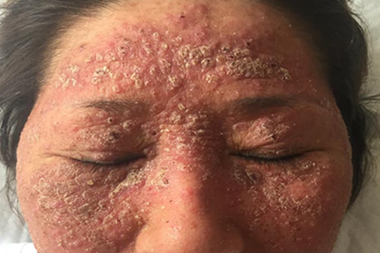 湿疹面部疙瘩图