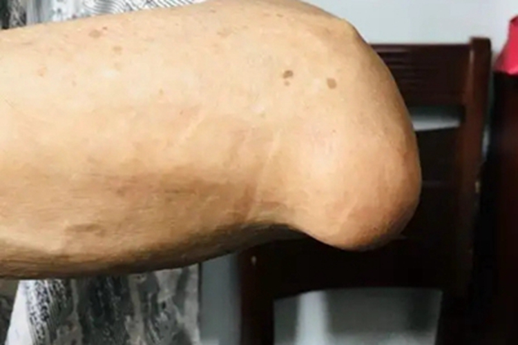 痛风肘部肿块图