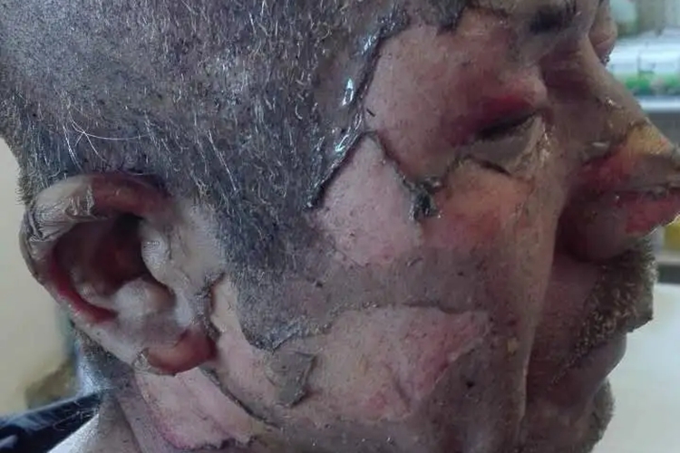 三度烧伤脸部图