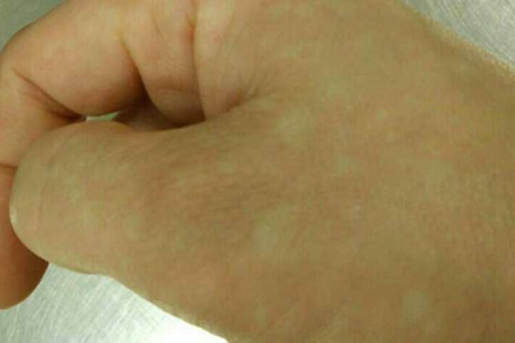 花斑糠疹手背上有好多白斑图