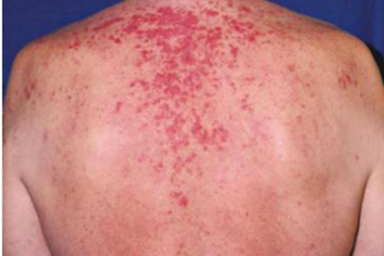 亚急性皮肤型红斑狼疮症状图