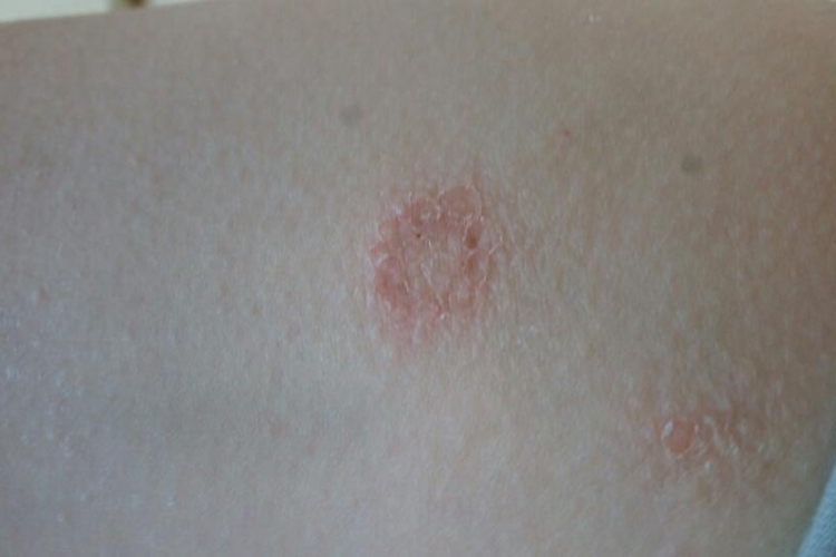 钱币状湿疹红斑上有鳞屑图