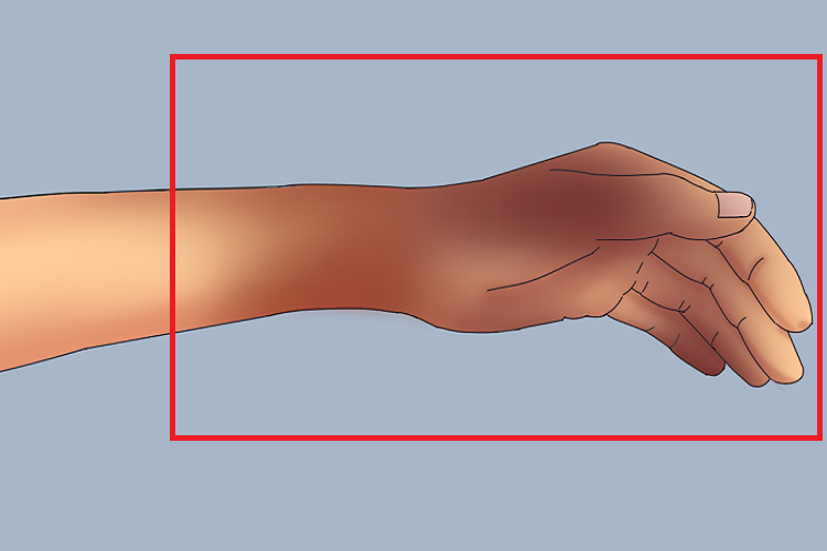 smith骨折铁铲样畸形图