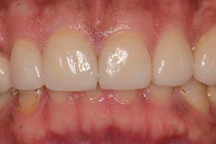 牙龈退缩牙根轻微暴露图