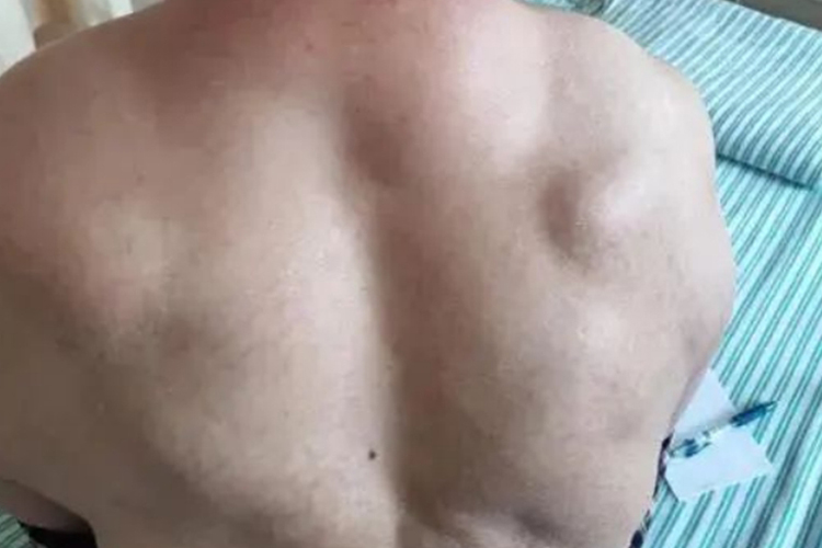 多发性脂肪瘤后背长瘤子疙瘩图