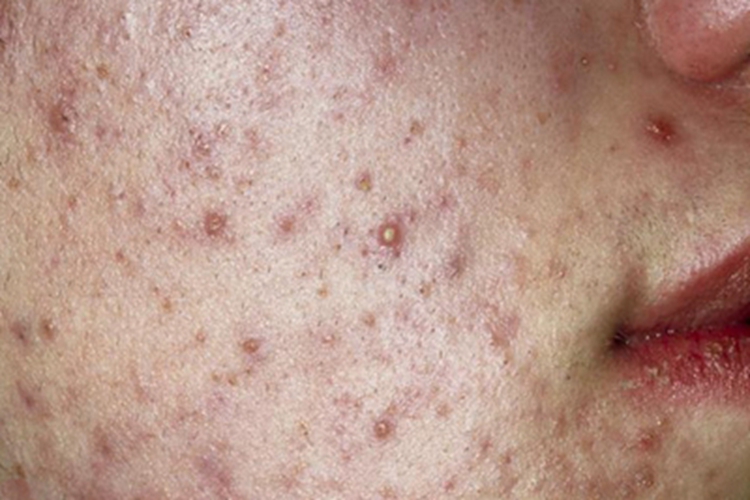 痤疮脸上长疙瘩有小白点图