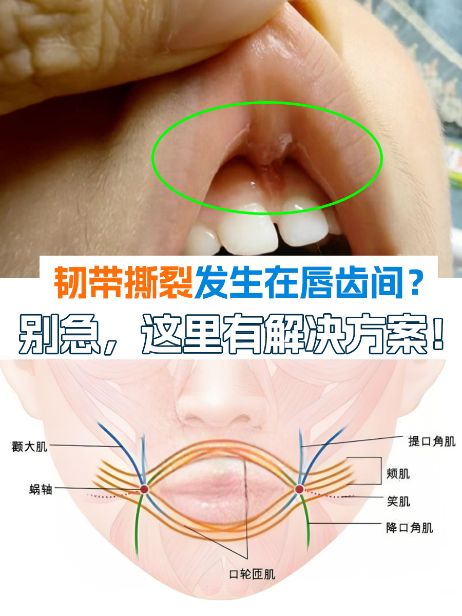 韧带撕裂发生在唇齿间？别急，这里有解决方案！