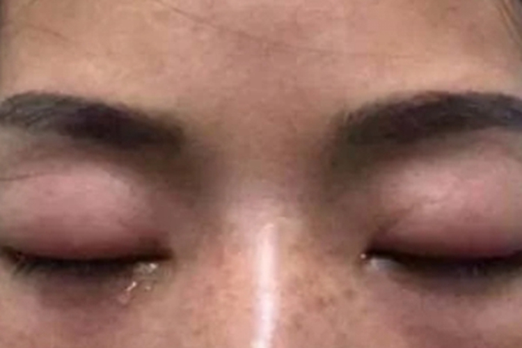 眼眶血肿眼睑水肿图 眼眶血肿眼睑水肿图