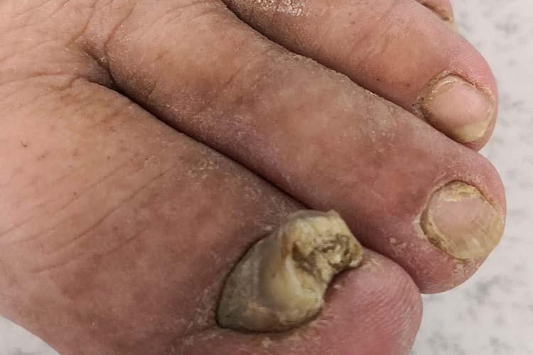 甲癣脚趾甲变形图