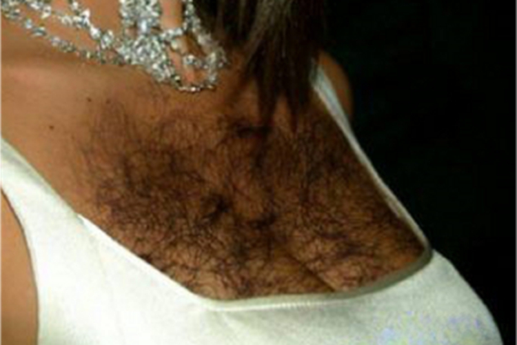 妇女多毛症胸部毛发过长图 妇女多毛症胸部毛发过长图