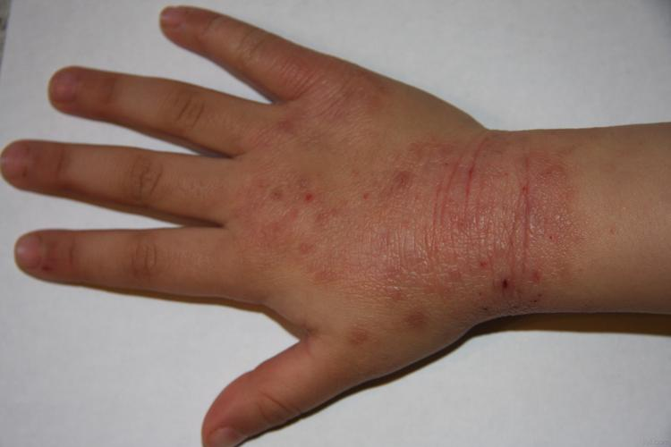 孩子亚急性湿疹图 孩子亚急性湿疹图