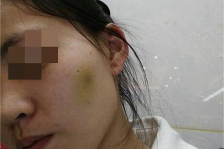 挫伤面部皮肤发青图