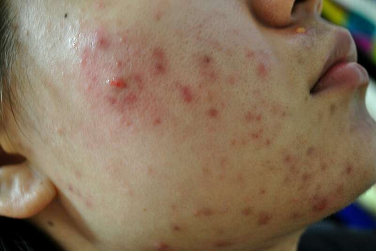 面部糖皮质激素依赖性皮炎图