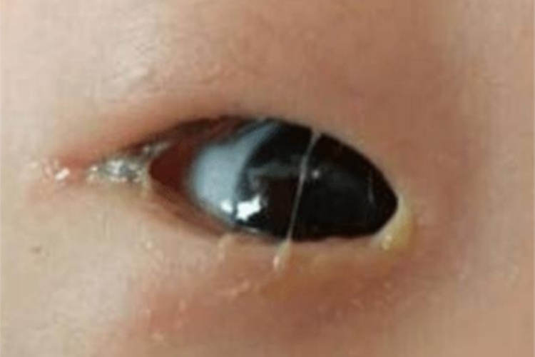 儿童结膜炎眼部化脓图