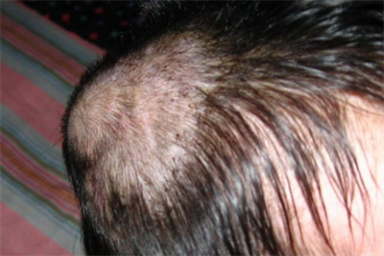 皮下血肿头部肿块图