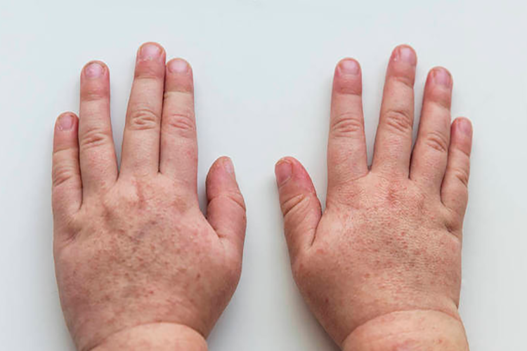 磺胺过敏猩红热样皮疹图 磺胺过敏猩红热样皮疹图