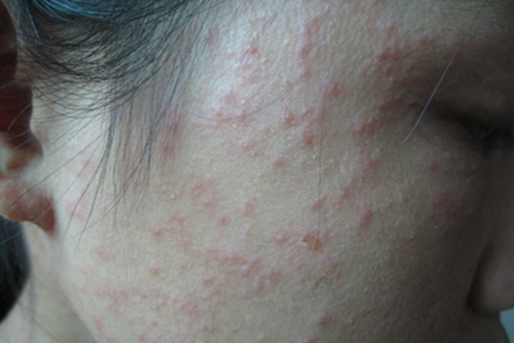 战壕热症状图 战壕热症状图