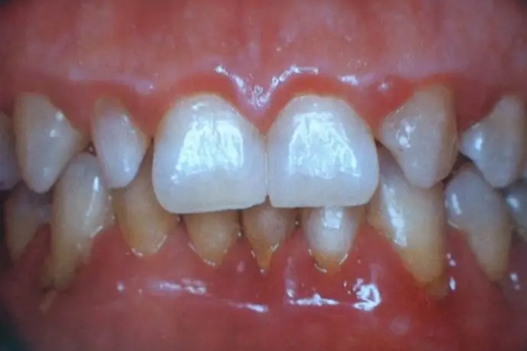 牙龈炎牙龈红肿图