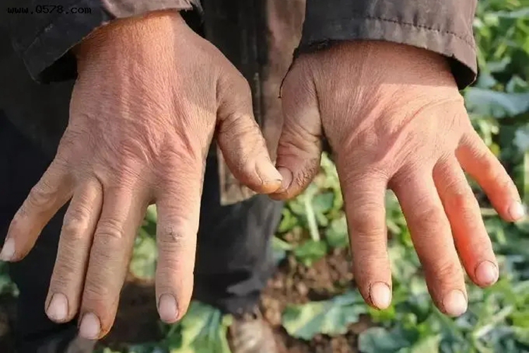 光老化手背皮肤粗糙图