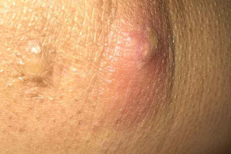 屁股上皮脂腺囊肿图