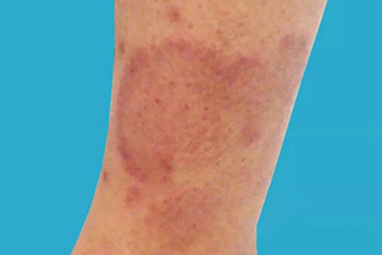 盘状红斑狼疮小腿红斑图