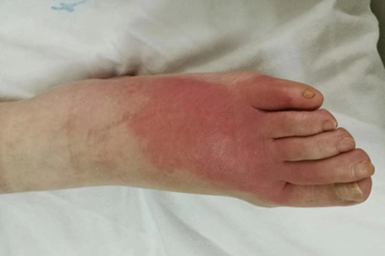 急性湿疹脚背图