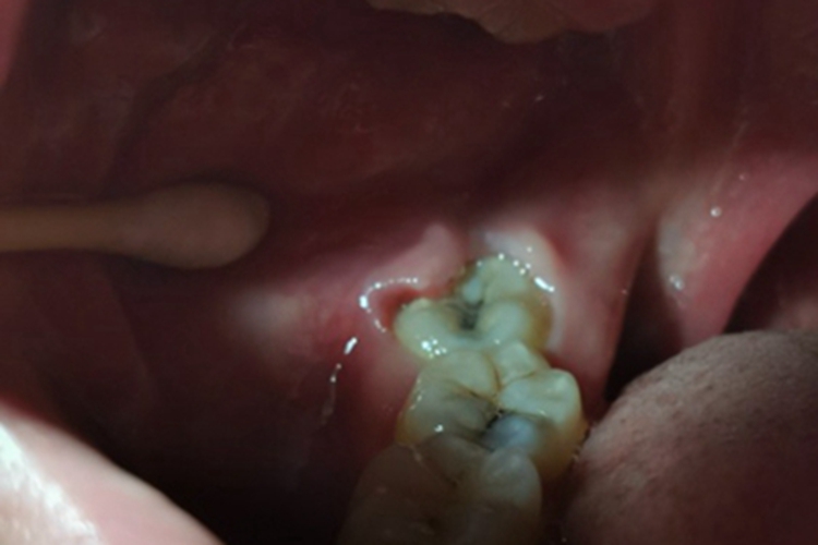 智齿冠周炎牙龈肿起来图 智齿冠周炎牙龈肿起来图